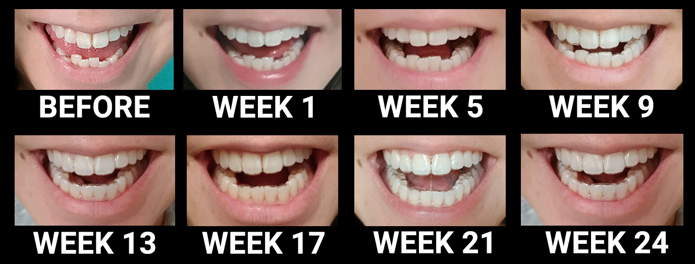 is smile direct good